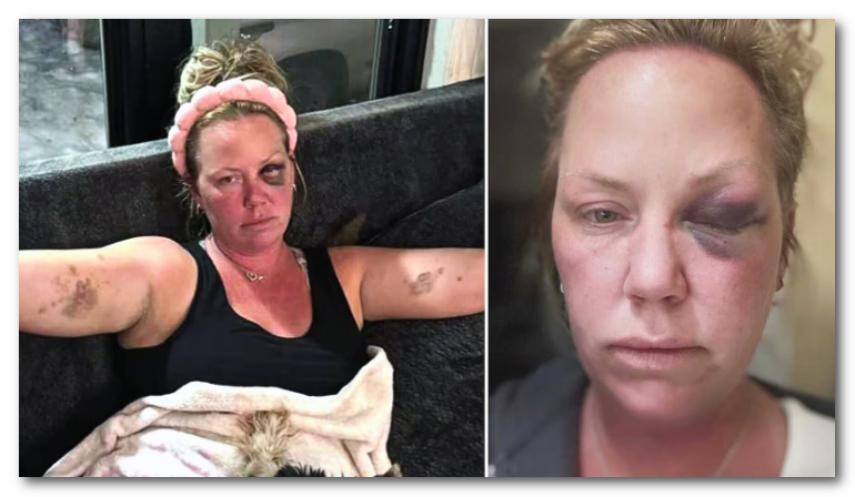 安省女子海外度假遭同胞毆打 眼睛被打至瘀青